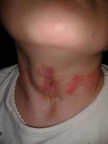 Stoma.JPG